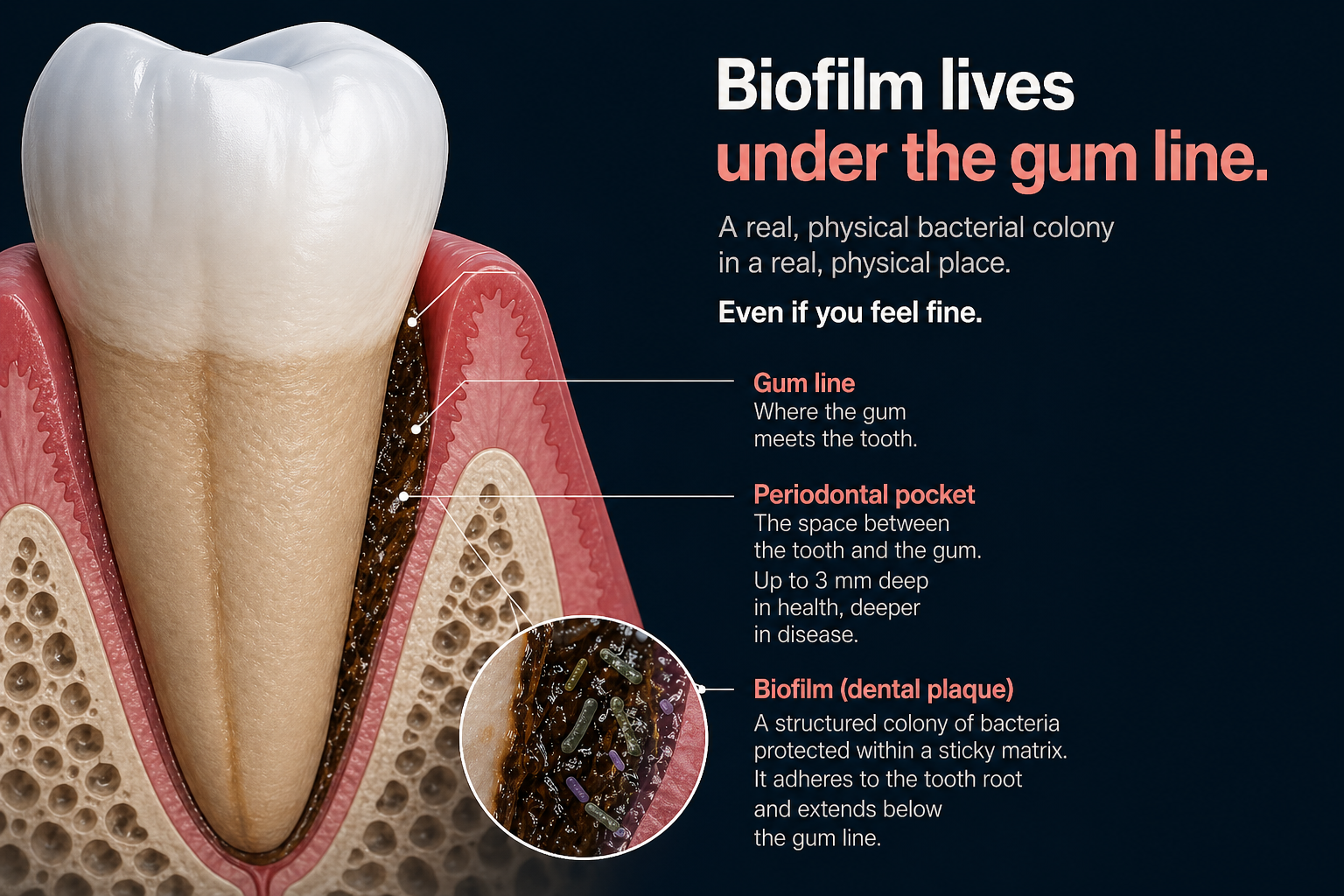 Anatomical cross-section of a tooth and gum showing the biofilm layer below the gumline