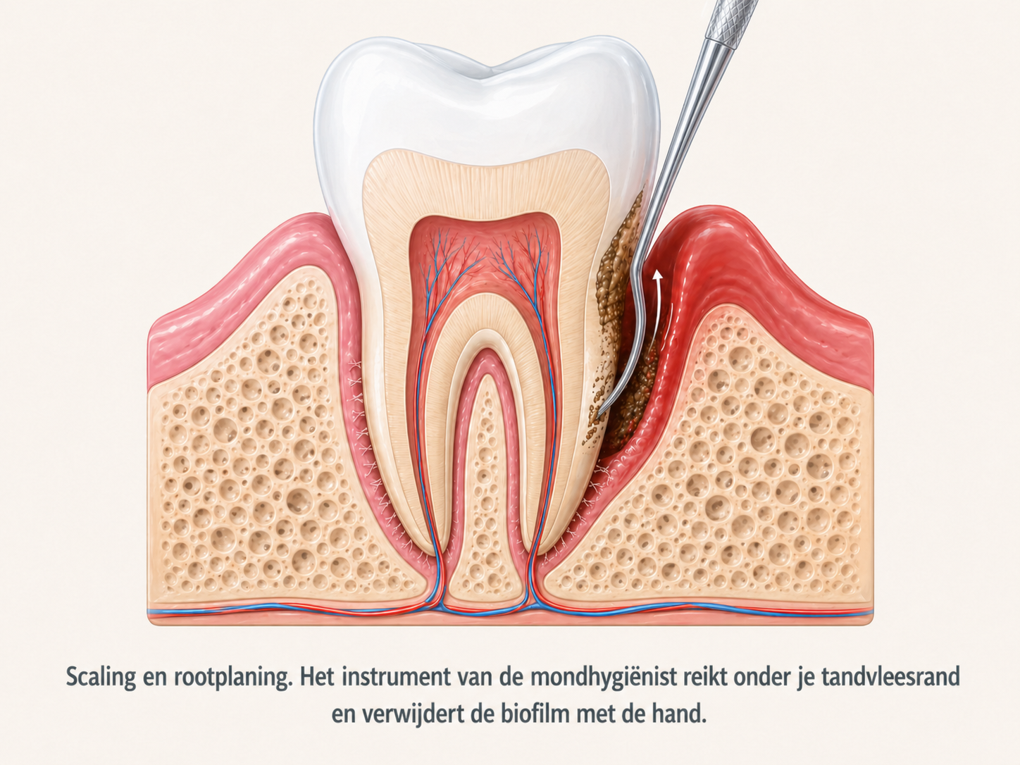 Scaling en rootplaning: het instrument van de mondhygiënist reikt onder de tandvleesrand en verwijdert de biofilm
